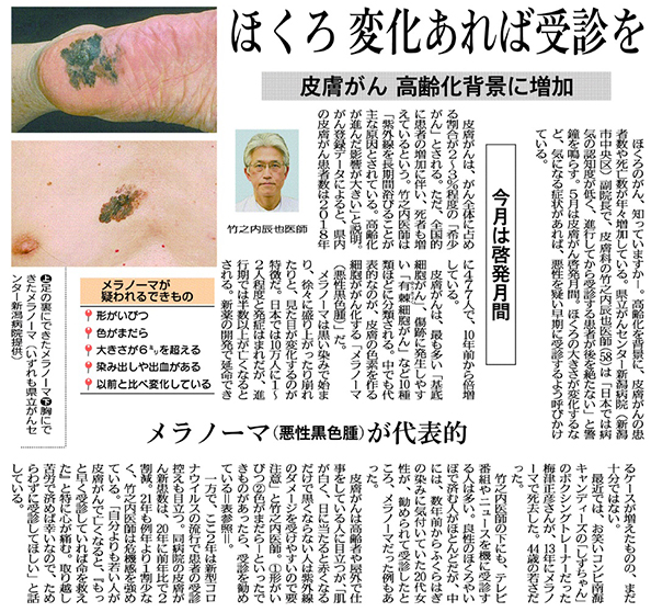 新聞：皮膚がん　高齢化背景に増加