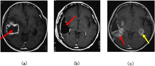 図４：グリオブラストーマの造影頭部MRI