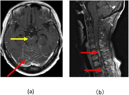 図８：髄膜癌腫症の造影頭部MRIと脊髄MRI