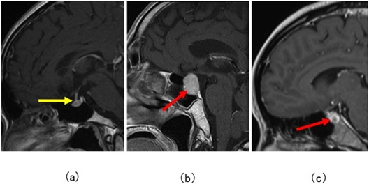 図11：脳下垂体の造影頭部MRI矢状断（横から見た図で、向かって左が前方）