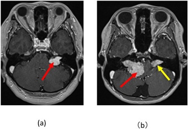 図12：神経鞘腫（聴神経腫瘍）２例の造影頭部MRI