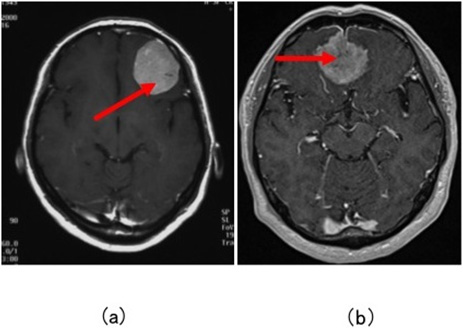 図14：髄膜腫２症例の造影頭部MRI