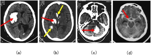 図15：頭蓋内出血の4症例の頭部CT