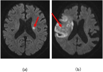 図16：脳梗塞２症例の頭部MRI/拡散強調画像。