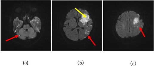 図17：トルーソー症候群の頭部MRI/拡散強調画像
