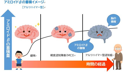 「アルツハイマー病」と「アミロイドβ蛋白」