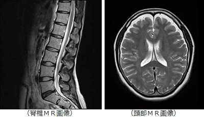 脊椎ＭＲ画像　頭部ＭＲ画像