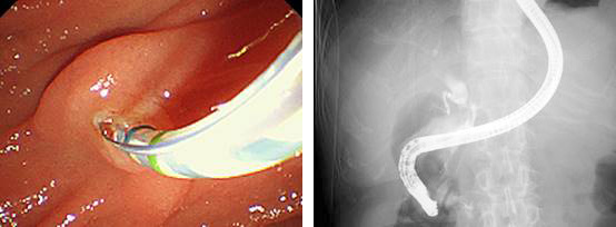 内視鏡的逆行性膵胆管造影検査（ERCP）