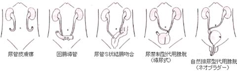 尿路変向法のいろいろ