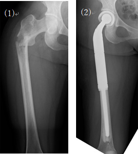 骨転移よる骨折(1)に対する人工骨頭置換術(2)