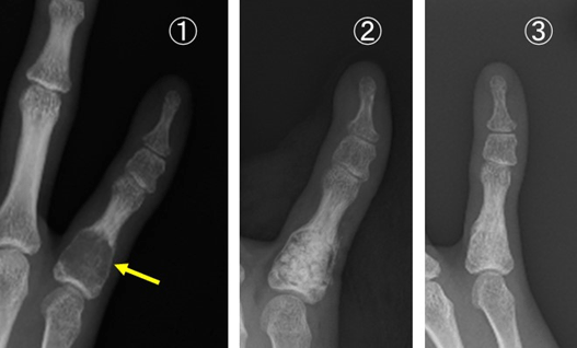 ①内軟骨腫の術前、②人工骨挿入直後、③半年後