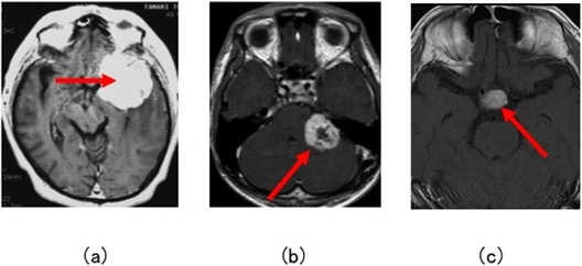 図２：良性脳腫瘍（髄外腫瘍）