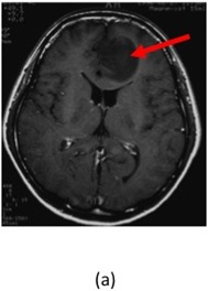 図３：アストロサイトーマの造影MRI。造影されない腫大した左前頭葉内側の脳皮質を認める