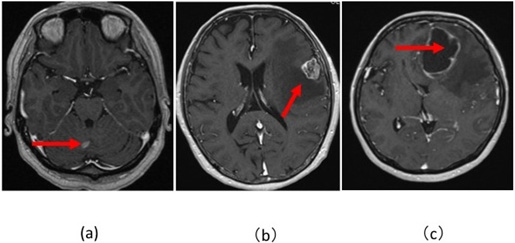 図５：転移性脳腫瘍３例の造影頭部MRI