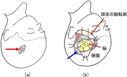 図６：穿頭術と開頭術