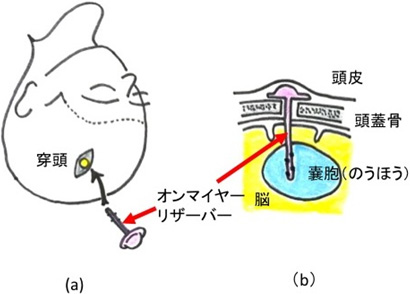 図７：オンマイヤリザーバー設置術