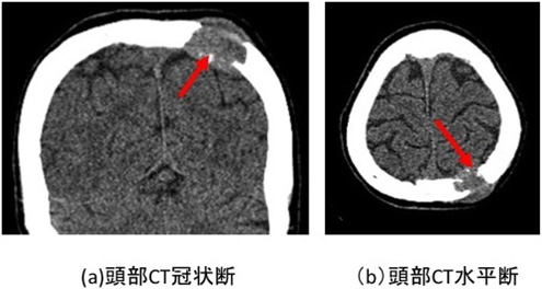 図９：転移性頭蓋骨腫瘍の頭部CT