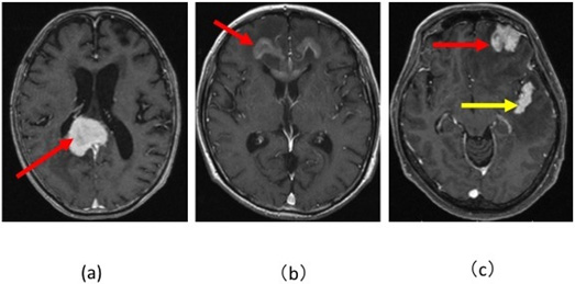 図10：悪性リンパ腫3症例の造影頭部MRI