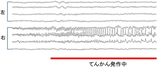 図18：右前頭運動領近傍腫瘍の脳波所見。脳波検査中に左上下肢の部分てんかんを生じたときの脳波異常