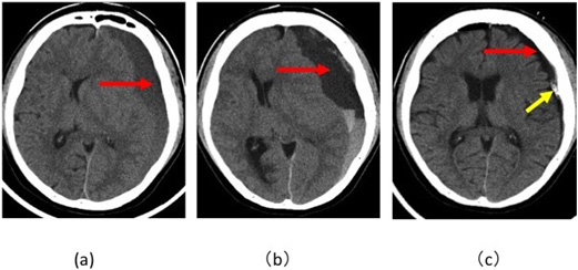 図20：慢性硬膜下血腫の経時的頭部CT