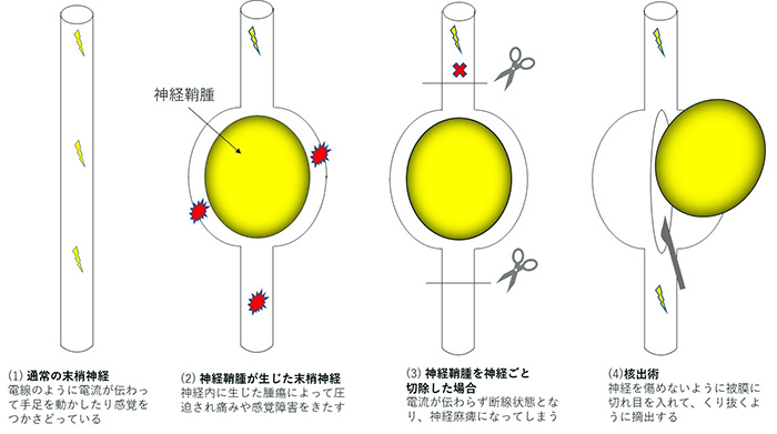 神経鞘腫