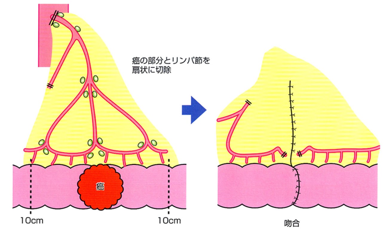 リンパ節郭清を伴う腸管切除