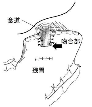 機能温存手術