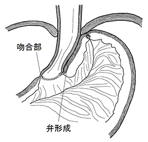 機能温存手術