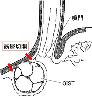 幽門保存胃切除術、噴門側胃切除術