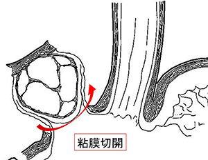 幽門保存胃切除術、噴門側胃切除術