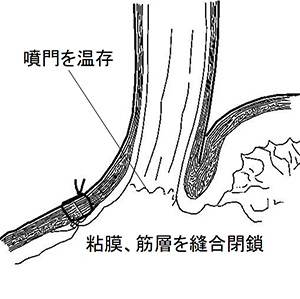 幽門保存胃切除術、噴門側胃切除術